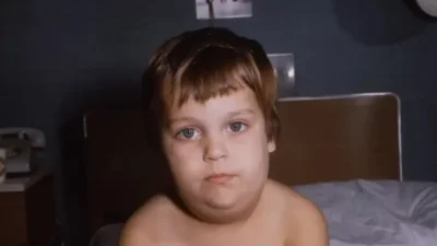 Bagaimana Agar Gondongan Kilat Kempis? Begini Cara Ampuhnya